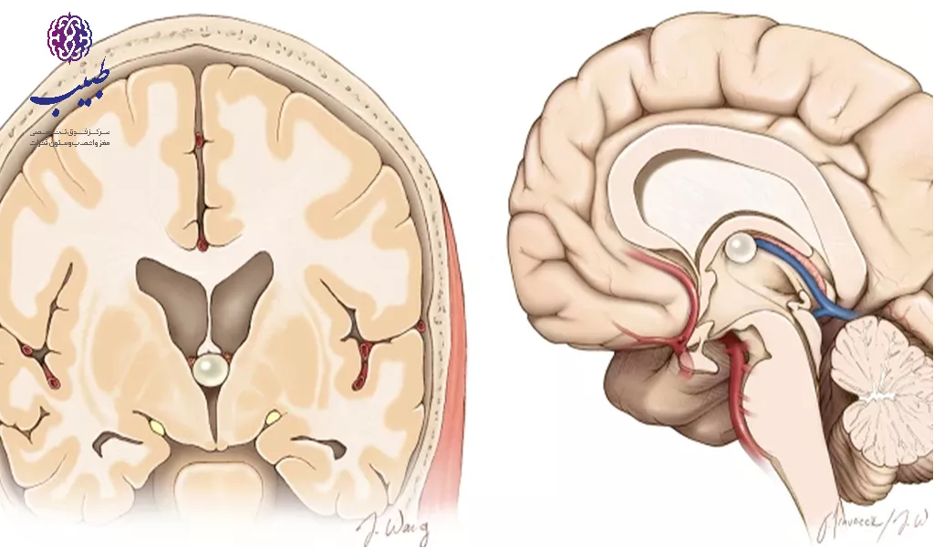 عوارض و خطرات احتمالی کیست کلوئید بطن سوم
