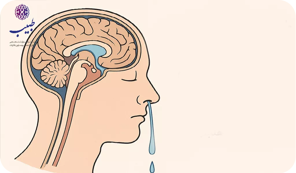 نشت مایع مغزی نخاعی از بینی چیست ؟